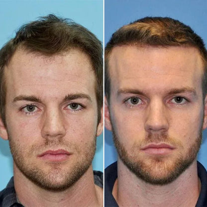 Reverse - Hair Growth Serum