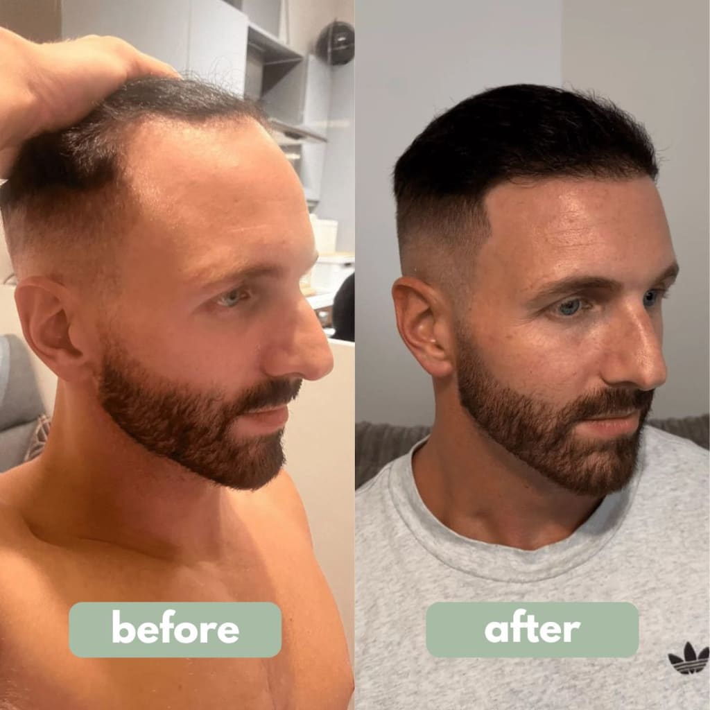 Reverse - Hair Growth Serum